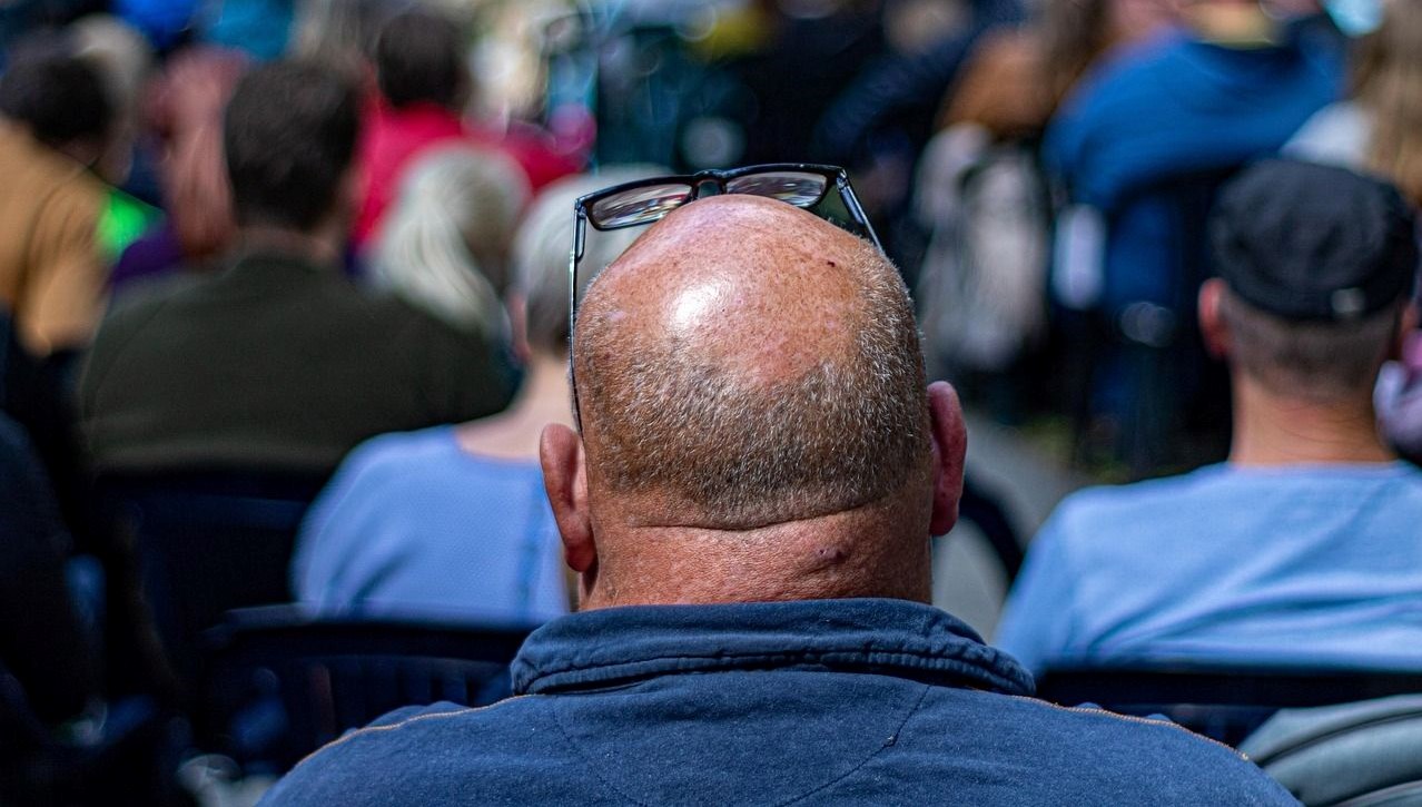 sac dokulmesinde yeni umut 20 gunde etkisini gosterdi WpB3flJg.jpg